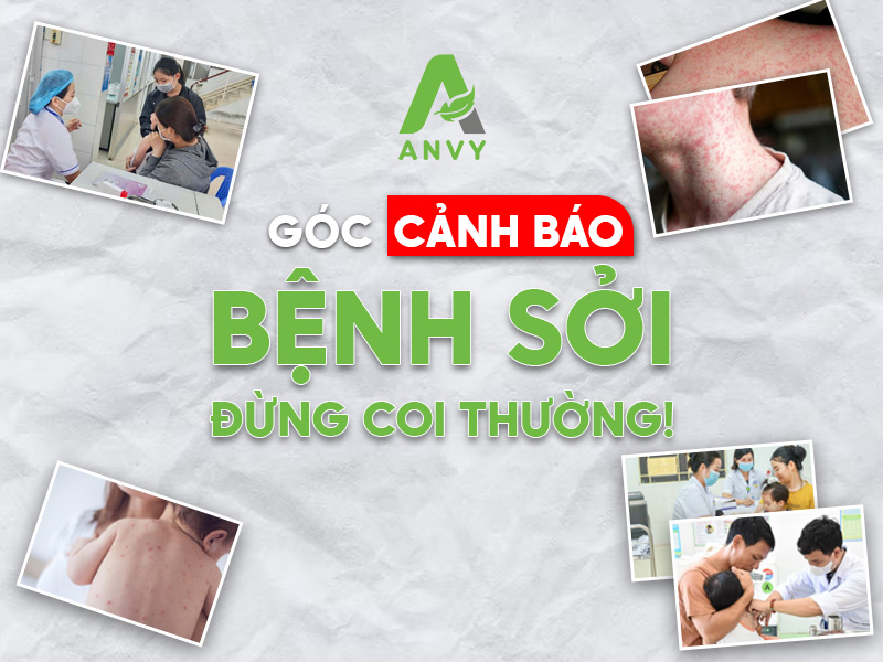 Cảnh báo bệnh sởi